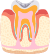 虫歯の前兆