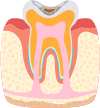 軽度の虫歯