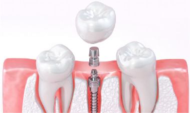 抜歯＋インプラント