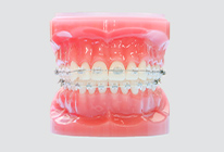 ワイヤー矯正(表側)