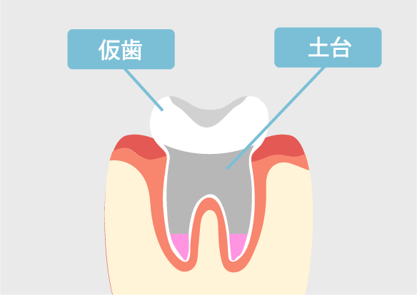 土台＋仮歯