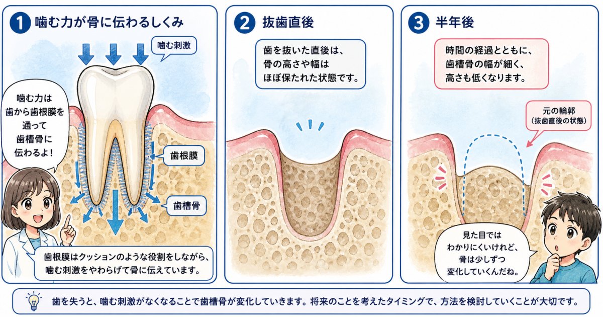 歯が抜けた後に顎の骨が溶けるメカニズムと進行スピード