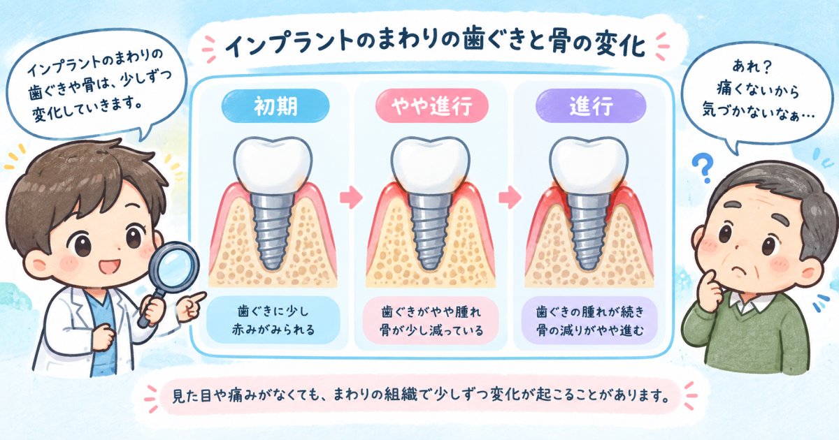 インプラント周囲炎が怖いとされる理由｜進行速度と発症の実際